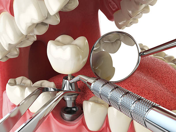 Best Urgent Care for Lost Fillings or Crowns in Berkeley, CA